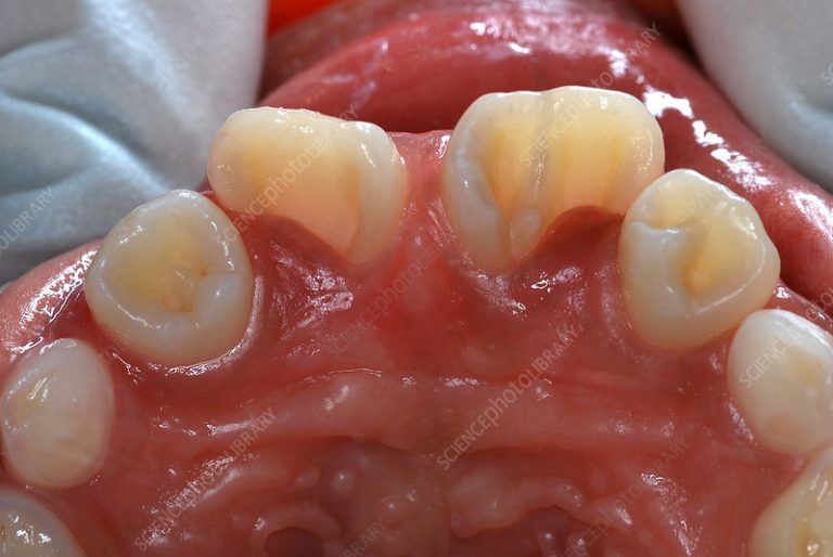 Dens in Dente image of upper maxillary arch