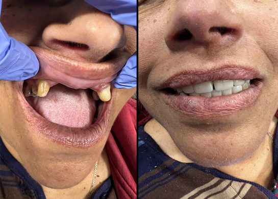 Before and after photos of a patient who received implant dentures. The left image shows the patient before with missing teeth, and the right photo shows the results of the implant denture placement.