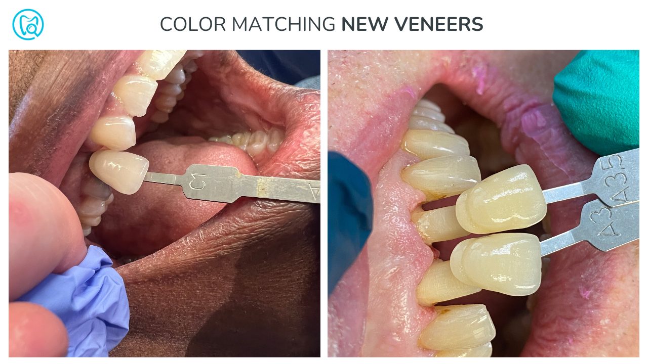 Color matching for Veneers
