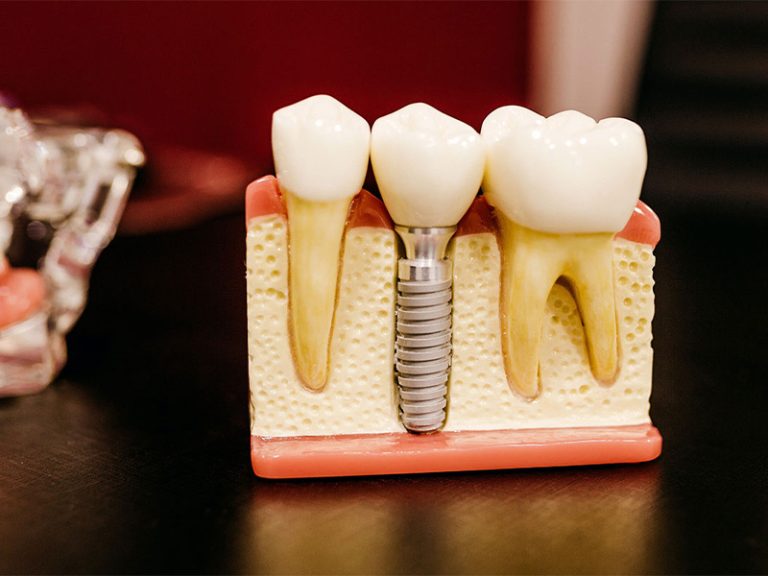 Model of Dental Implant showing how a dental implant screws into the mandible.