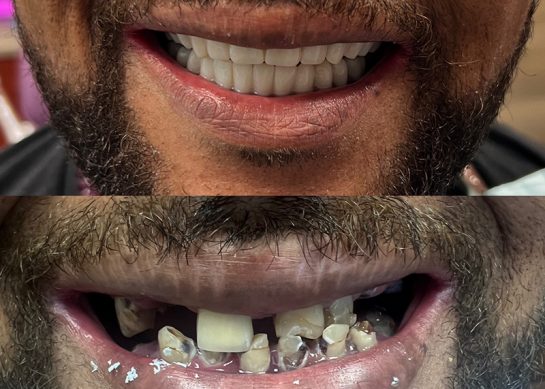 Before and after photos of a person with dental decay who received implant dentures. The lower photo shows a person with dental decay and the upper photo shows the results of an implant denture placement.