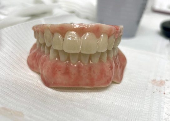 Upper and lower arches of an Implant Denture sitting on a dentist's work bench