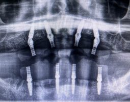 X-ray view of dental implants