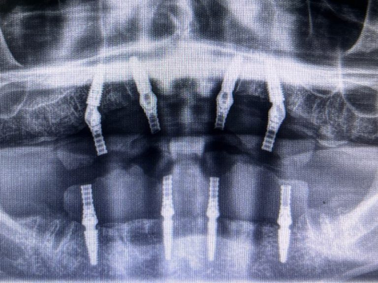 X-ray view of dental implants