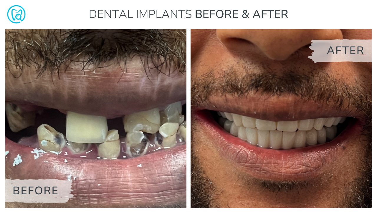 Dental Implants before and after photos showing the before patient on the left and a patient on the irght with full mouth hybrid implants