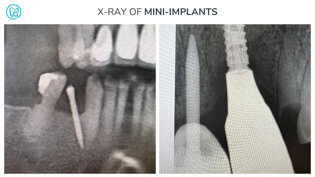 2 x-rays of implants taken on patients who received single tooth maxillary dental implants