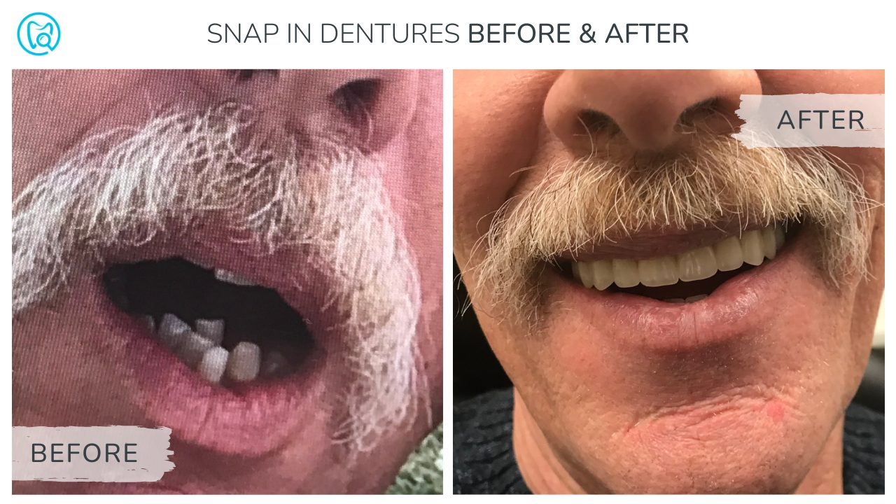 Before and after of a patient with low cost dental implants. The left photo shows crowding of the teeth and the right shows a bright smile after placement of implants