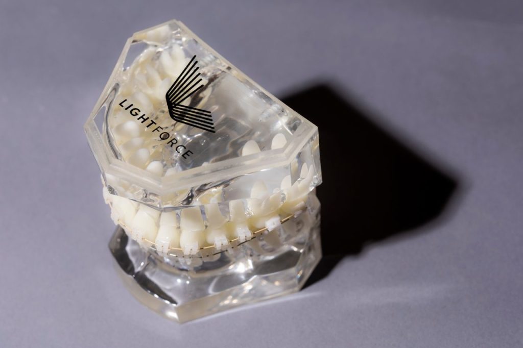 A set of example teeth equipped with light force braces.