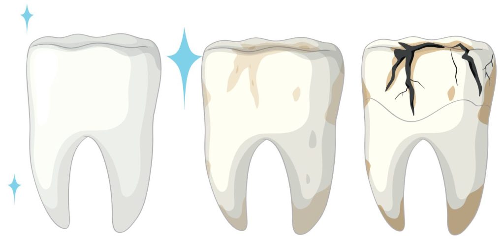 Stages of a cavity