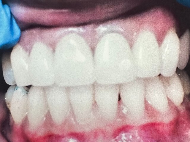 Porcelain crowns for better symmetry and harmony — After