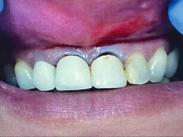 Porcelain crowns for better symmetry and harmony — Before